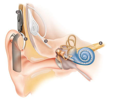 Cochlea-Implantat